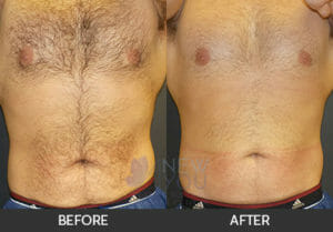 CoolSculpting® Before and After, Chicago, IL