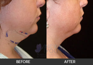 CoolSculpting® Before and After, Chicago, IL