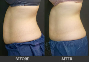 CoolSculpting® Before and After, Chicago, IL