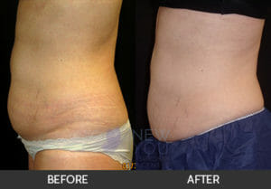 CoolSculpting® Before and After, Chicago, IL