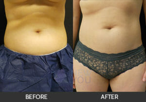 CoolSculpting® Before and After, Chicago, IL