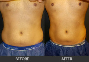 CoolSculpting® Before and After, Chicago, IL