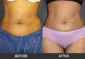 CoolSculpting® Before and After, Chicago, IL