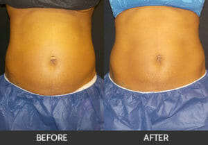 CoolSculpting® Before and After, Chicago, IL