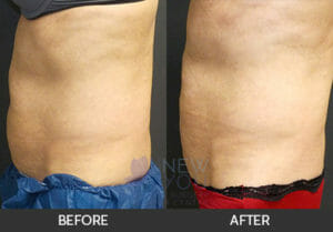 CoolSculpting® Before and After, Chicago, IL