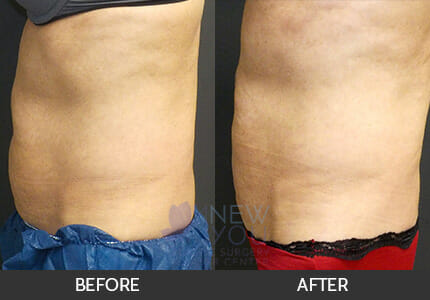 CoolSculpting® Gallery