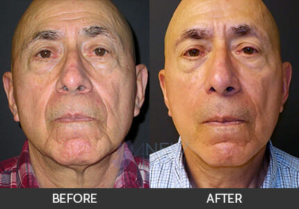 Male Facelift Before and After, Chicago, IL