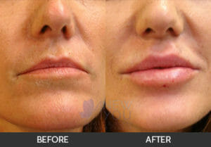 Lip Augmentation Before and After - Chicago, IL