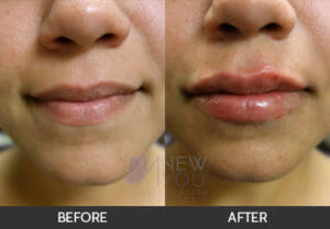 Lip Augmentation Before and After - Chicago, IL