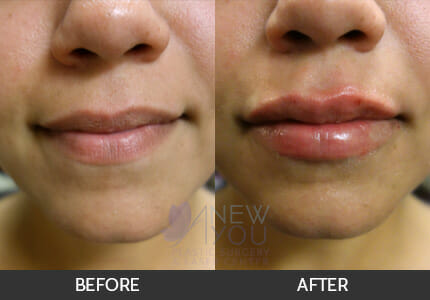 Lip Augmentation Gallery