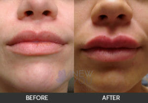 Lip Augmentation Before and After - Chicago, IL