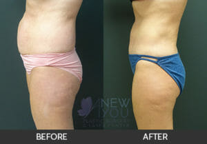 Tummy Tuck Before and After, Chicago, IL