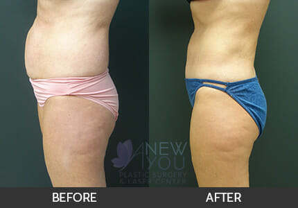 Tummy Tuck Gallery