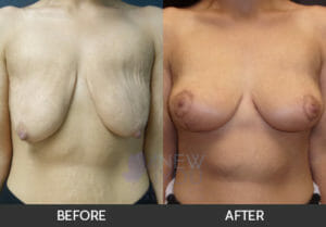 Breast Lift with Augmentation Before and After, Chicago, IL