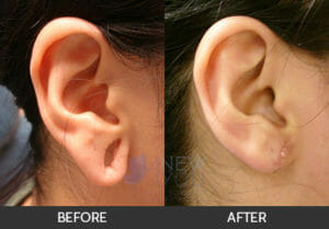 Earlobe Repair Before and After, Chicago, IL