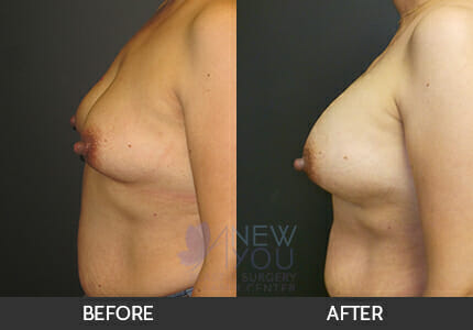 Breast Augmentation Gallery