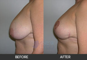 Breast Reduction Before and After, Chicago, IL