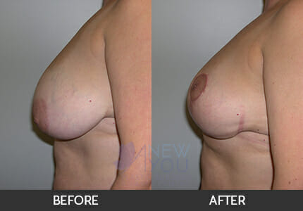 Breast Reduction Gallery