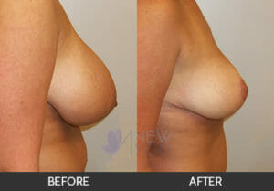 Breast Reduction Before and After, Chicago, IL