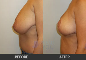 Breast Reduction Before and After, Chicago, IL