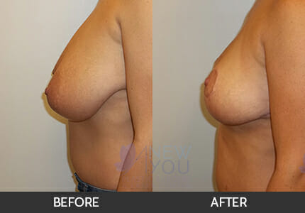 Breast Reduction Gallery