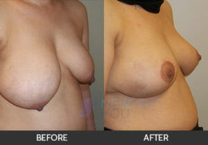 Breast Reduction Before and After, Chicago, IL