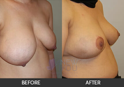 Breast Reduction Gallery