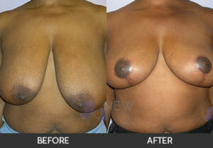 Breast Reduction Before and After, Chicago, IL