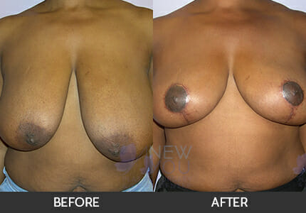 Breast Reduction Gallery