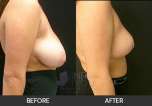 Breast Reduction Before and After, Chicago, IL