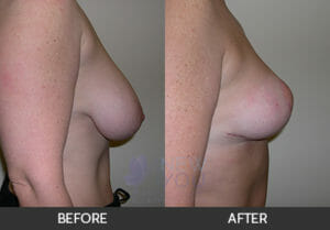 Breast Reduction Before and After, Chicago, IL