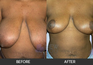 Breast Reduction Before and After, Chicago, IL