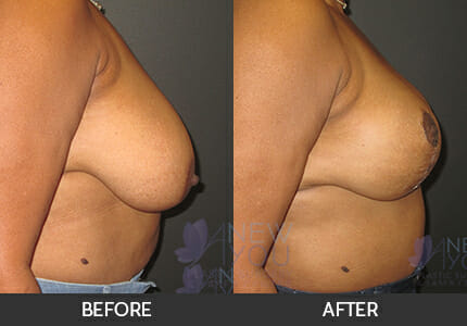 Breast Reduction Gallery