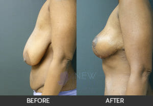 Breast Reduction Before and After, Chicago, IL