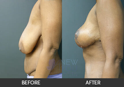 Breast Reduction Gallery