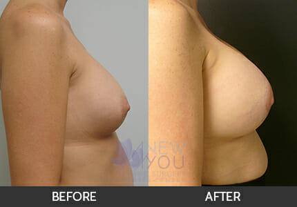 Breast Revision Gallery