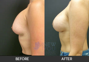 Breast Revision Before and After, Chicago, IL