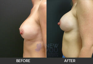 Breast Revision Before and After, Chicago, IL