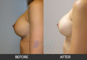 Breast Revision Before and After, Chicago, IL