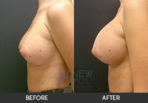 Breast Revision Before and After, Chicago, IL