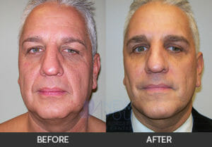 Male Facelift Before and After, Chicago, IL