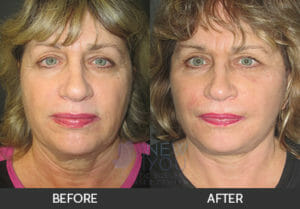 Female Facelift Before and After, Chicago, IL