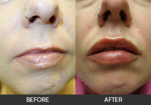 Lip Augmentation Before and After - Chicago, IL