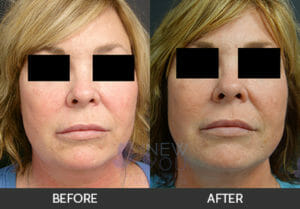 Liposuction Before and After, Chicago, IL