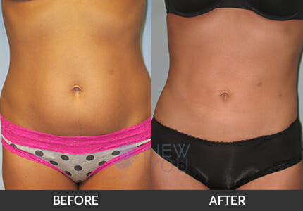 Liposuction Gallery