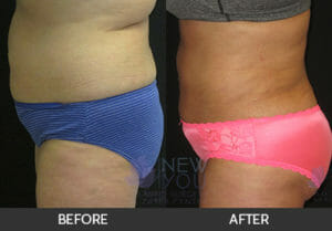 Liposuction Before and After, Chicago, IL