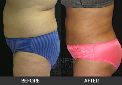 Liposuction Gallery