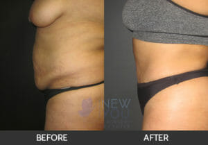 Tummy Tuck Before and After, Chicago, IL