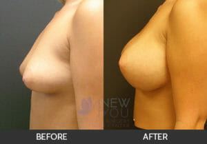 Breast Augmentation Before and After, Chicago, IL