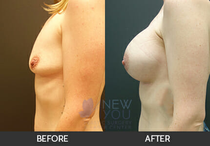 Breast Augmentation Gallery